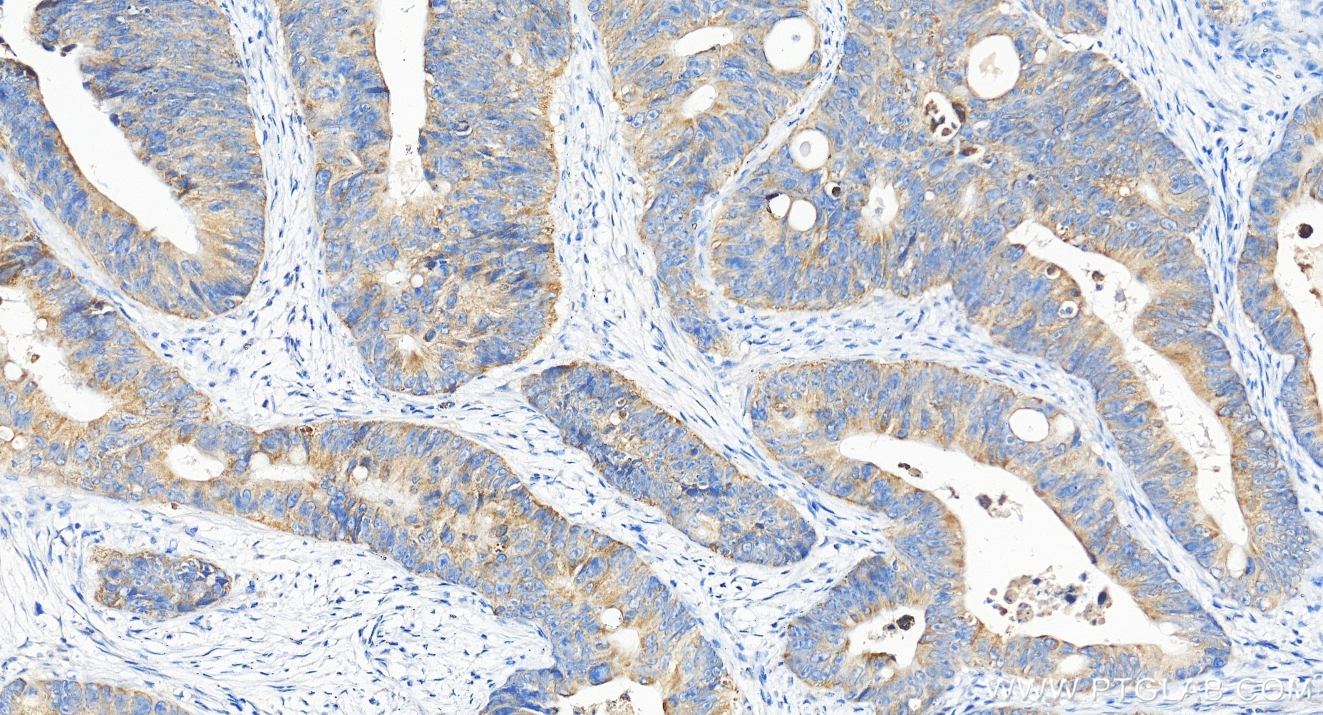 Immunohistochemical analysis of paraffin-embedded human colon cancer tissue slide using 85419-4-RR (PTGES2 antibody) at dilution of 1:200 (under 20x lens). Heat mediated antigen retrieval with Tris-EDTA buffer (pH 9.0). Immunohistochemistry (IHC) staining of human colon cancer tissue using PTGES2 Recombinant monoclonal antibody (85419-4-RR)