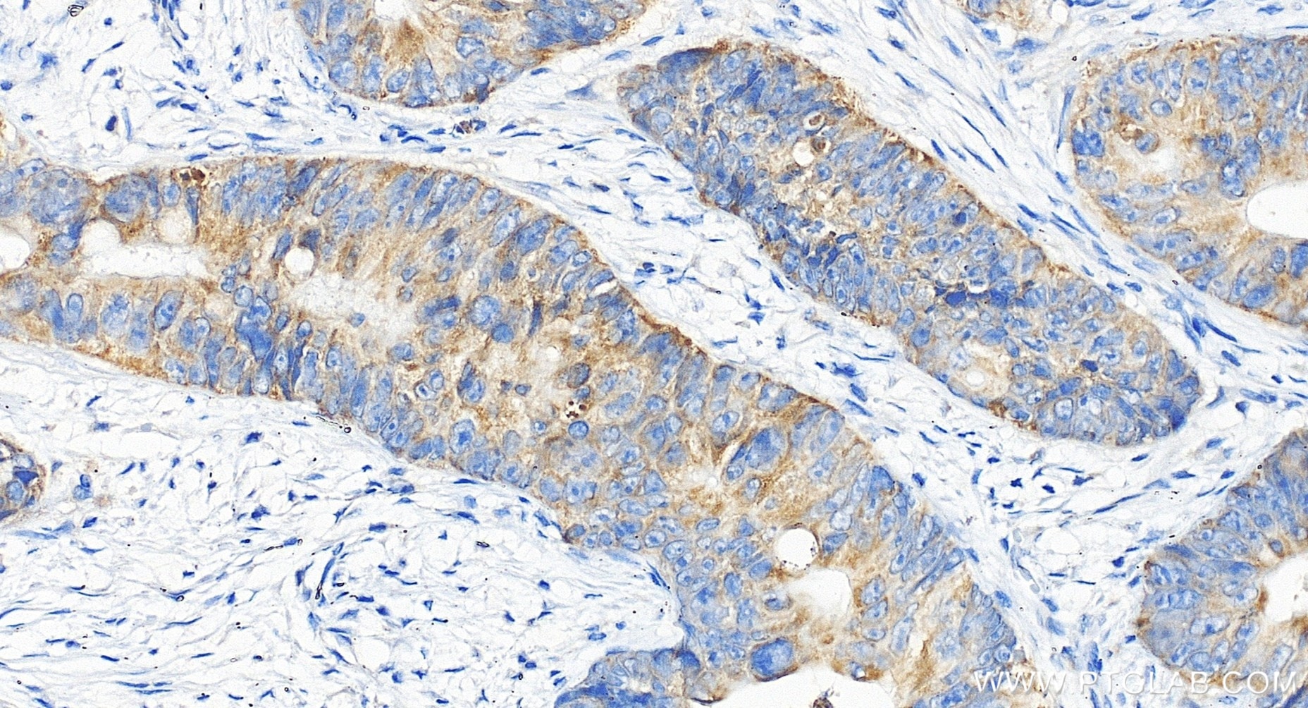 Immunohistochemical analysis of paraffin-embedded human colon cancer tissue slide using 85419-4-RR (PTGES2 antibody) at dilution of 1:200 (under 20x lens). Heat mediated antigen retrieval with Tris-EDTA buffer (pH 9.0). Immunohistochemistry (IHC) staining of human colon cancer tissue using PTGES2 Recombinant monoclonal antibody (85419-4-RR)
