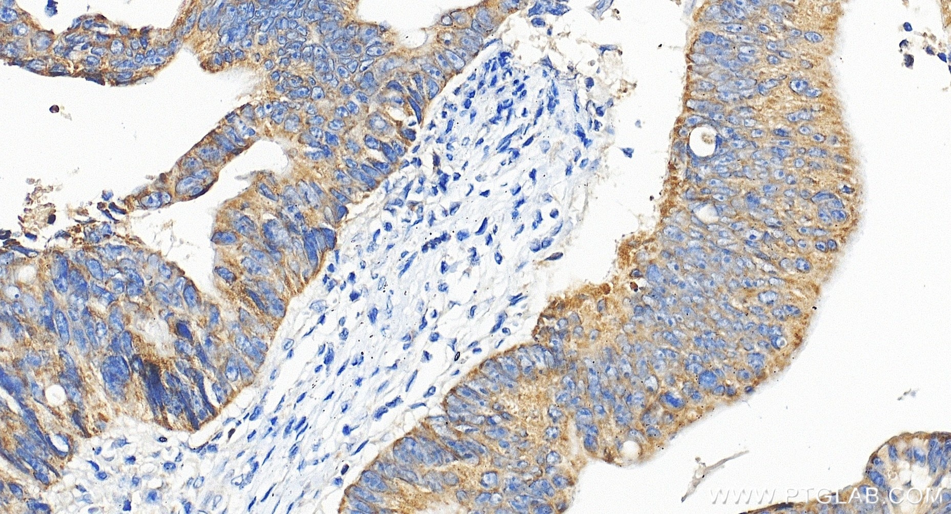 Immunohistochemical analysis of paraffin-embedded human colon cancer tissue slide using 85419-4-RR (PTGES2 antibody) at dilution of 1:200 (under 40x lens). Heat mediated antigen retrieval with Tris-EDTA buffer (pH 9.0). Immunohistochemistry (IHC) staining of human colon cancer tissue using PTGES2 Recombinant monoclonal antibody (85419-4-RR)