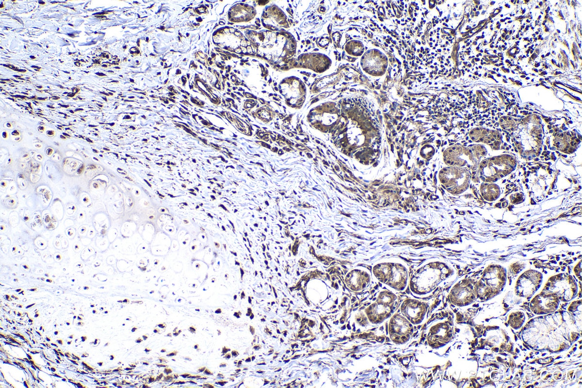 IHC staining of human lung cancer using 15216-1-AP