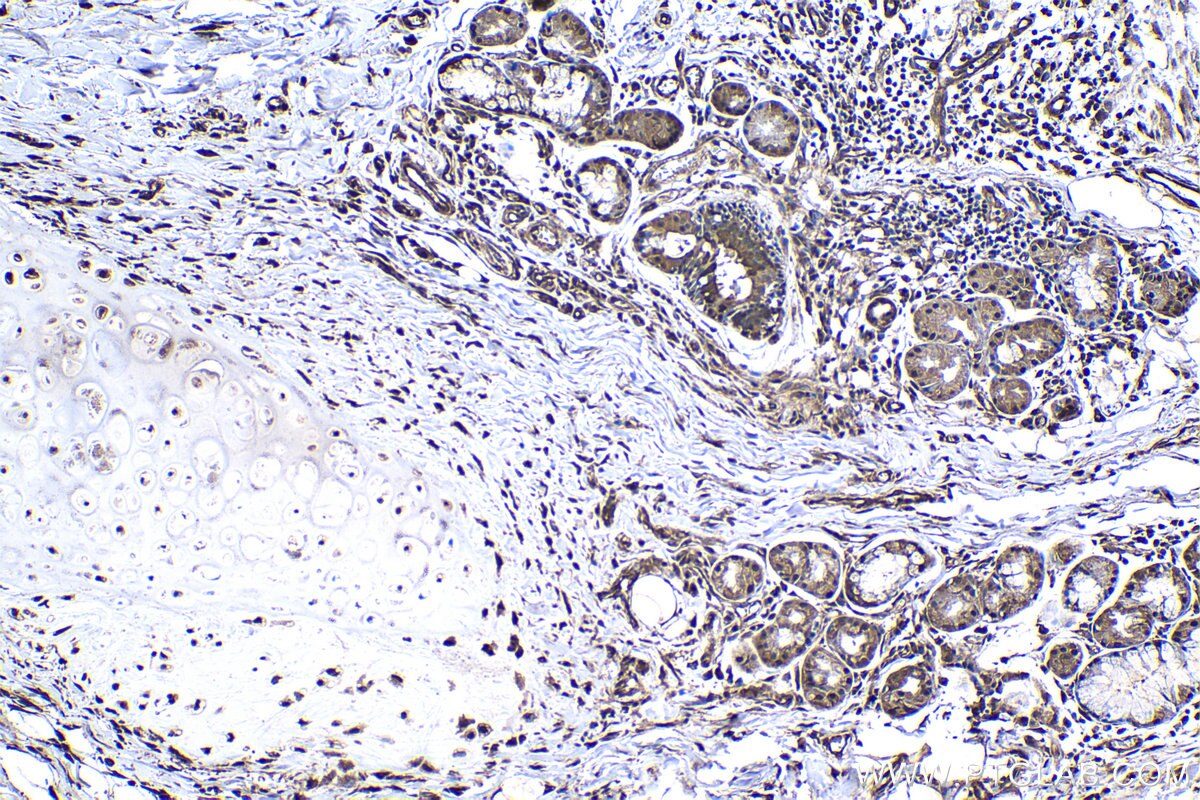 Immunohistochemistry (IHC) staining of human lung cancer tissue using PTGES3 Polyclonal antibody (15216-1-AP)