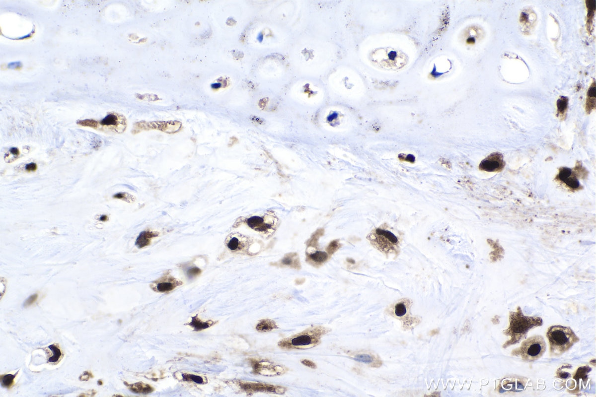 Immunohistochemistry (IHC) staining of human lung cancer tissue using PTGES3 Polyclonal antibody (15216-1-AP)