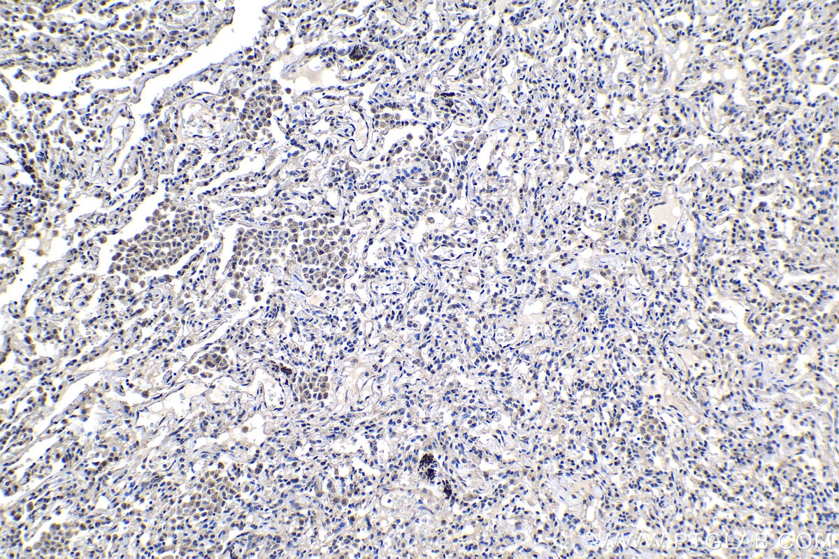 Immunohistochemistry (IHC) staining of human lung cancer tissue using PTGES3 Polyclonal antibody (15216-1-AP)