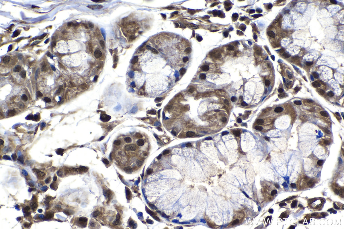 IHC staining of human lung cancer using 15216-1-AP