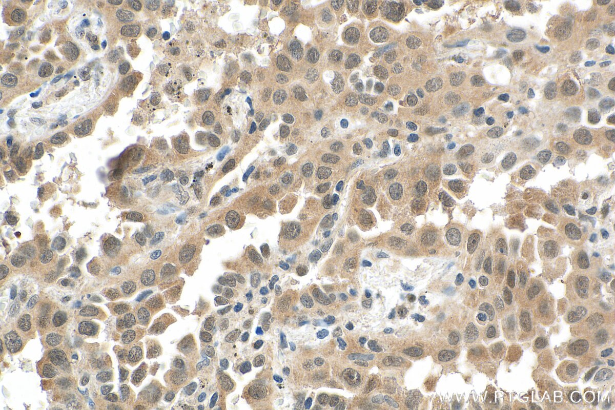 Immunohistochemistry (IHC) staining of human lung cancer tissue using PTGES3 Monoclonal antibody (67736-1-Ig)