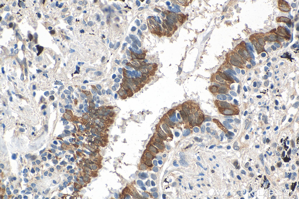 Immunohistochemistry (IHC) staining of human lung cancer tissue using PTGES3 Monoclonal antibody (67736-1-Ig)