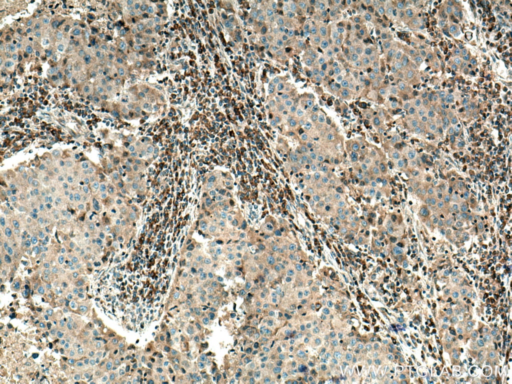 Immunohistochemistry (IHC) staining of human breast cancer tissue using COX2/ Cyclooxygenase 2/ PTGS2 Polyclonal antibody (12375-1-AP)