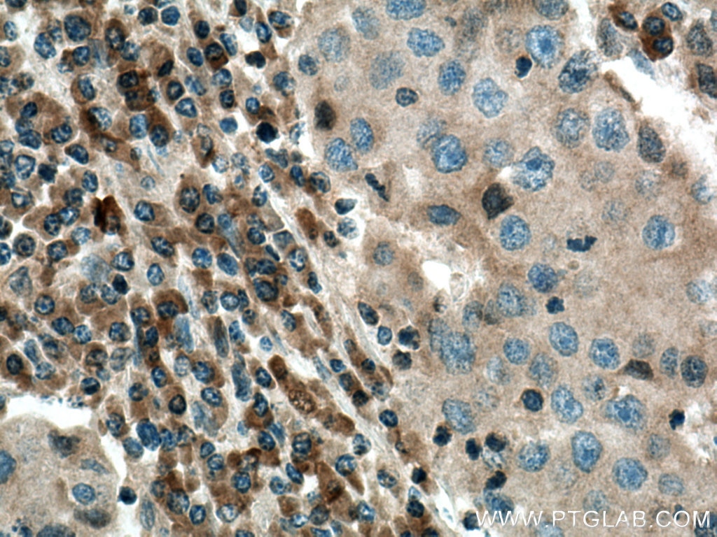 Immunohistochemistry (IHC) staining of human breast cancer tissue using COX2/ Cyclooxygenase 2/ PTGS2 Polyclonal antibody (12375-1-AP)