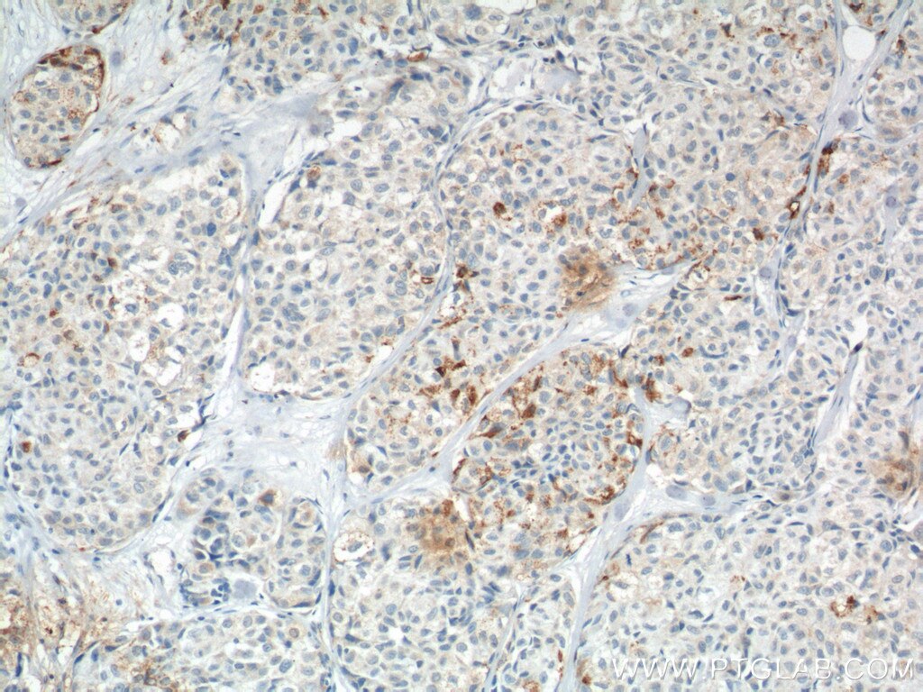 IHC staining of human lung cancer using 12375-1-AP