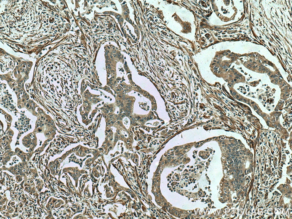 Immunohistochemistry (IHC) staining of human pancreas cancer tissue using PTH1R Polyclonal antibody (24275-1-AP)