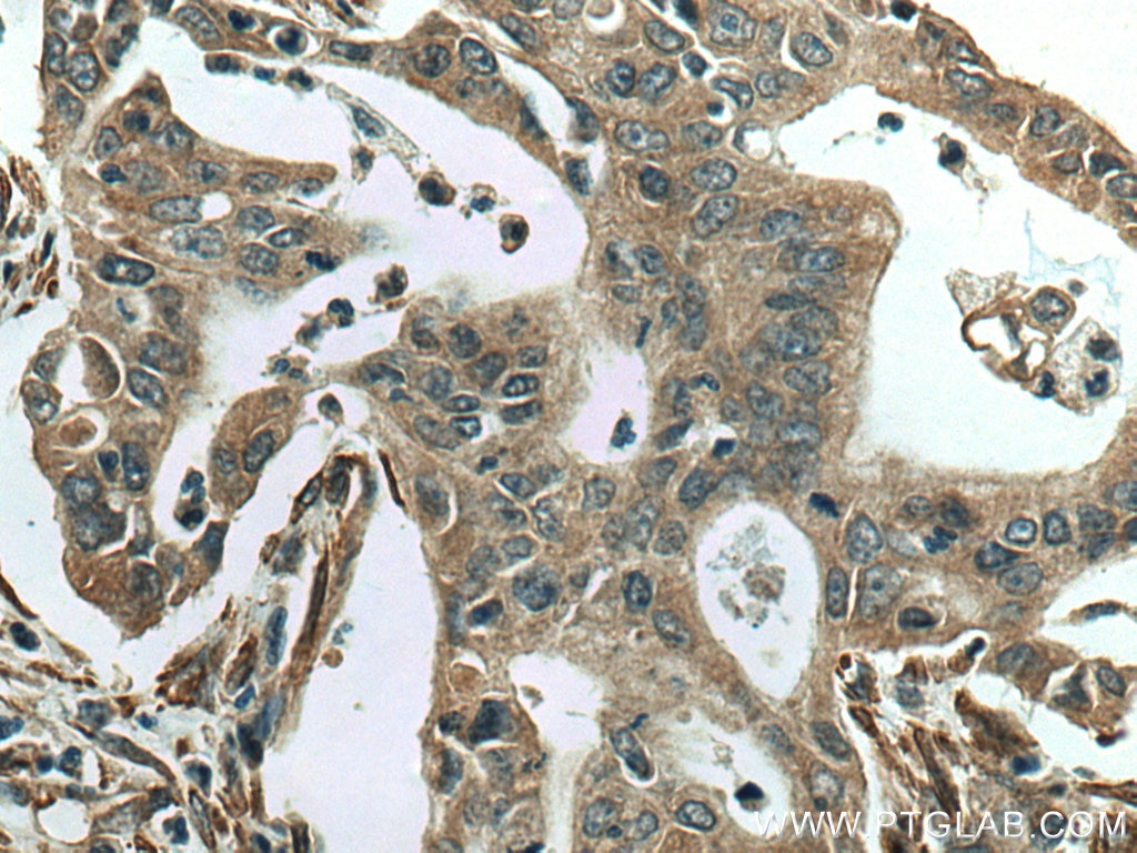 Immunohistochemistry (IHC) staining of human pancreas cancer tissue using PTH1R Polyclonal antibody (24275-1-AP)