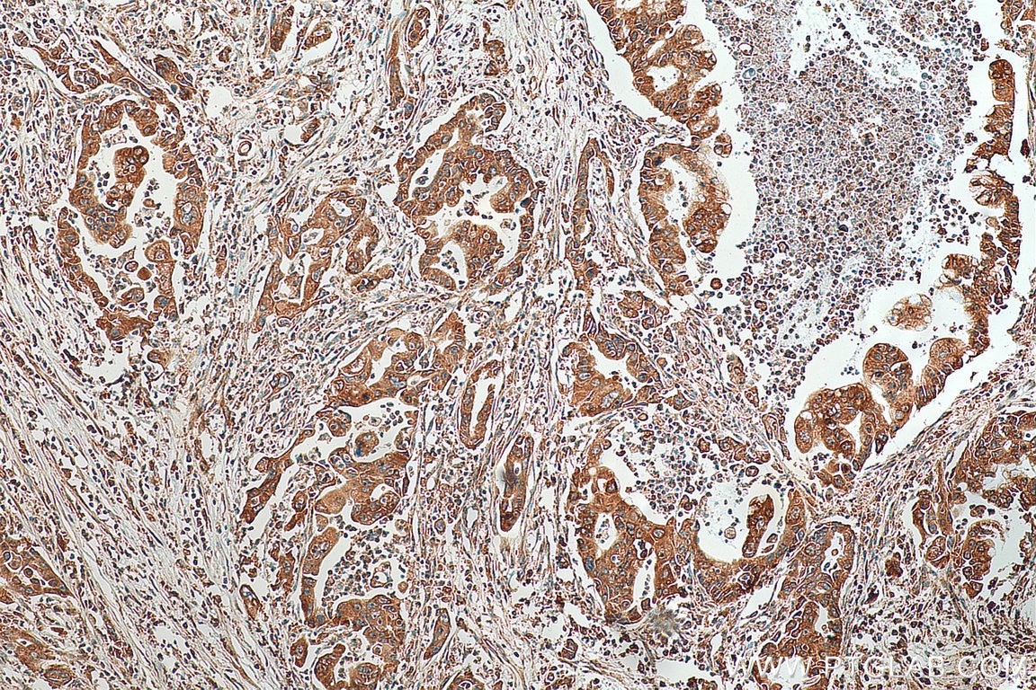 Immunohistochemistry (IHC) staining of human pancreas cancer tissue using PTH1R Polyclonal antibody (29115-1-AP)