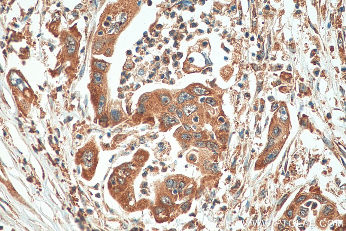 Immunohistochemistry (IHC) staining of human pancreas cancer tissue using PTH1R Polyclonal antibody (29115-1-AP)