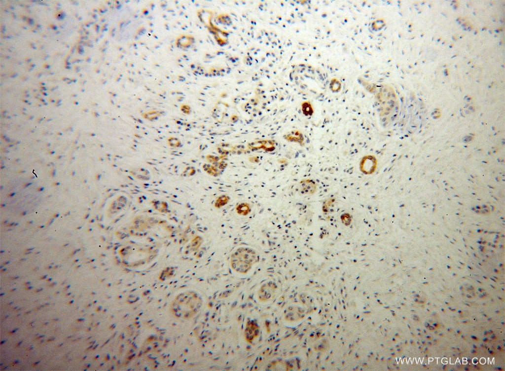 Immunohistochemistry (IHC) staining of human pancreas cancer tissue using PTH2R Polyclonal antibody (14166-1-AP)