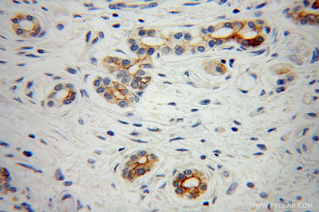 Immunohistochemistry (IHC) staining of human pancreas cancer tissue using PTH2R Polyclonal antibody (14166-1-AP)