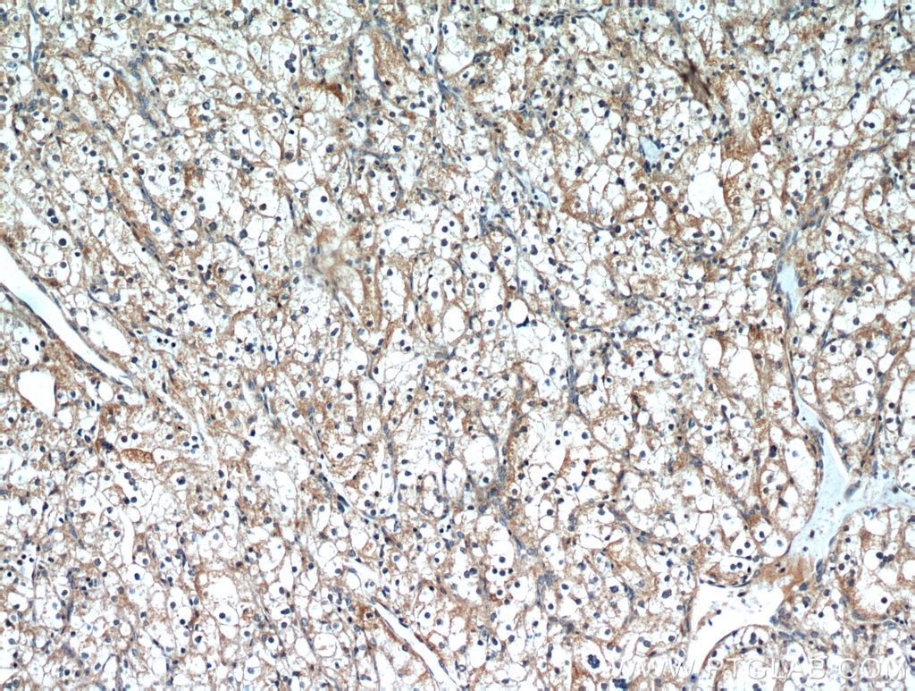 Immunohistochemistry (IHC) staining of human renal cell carcinoma tissue using PTH2R Polyclonal antibody (14166-1-AP)