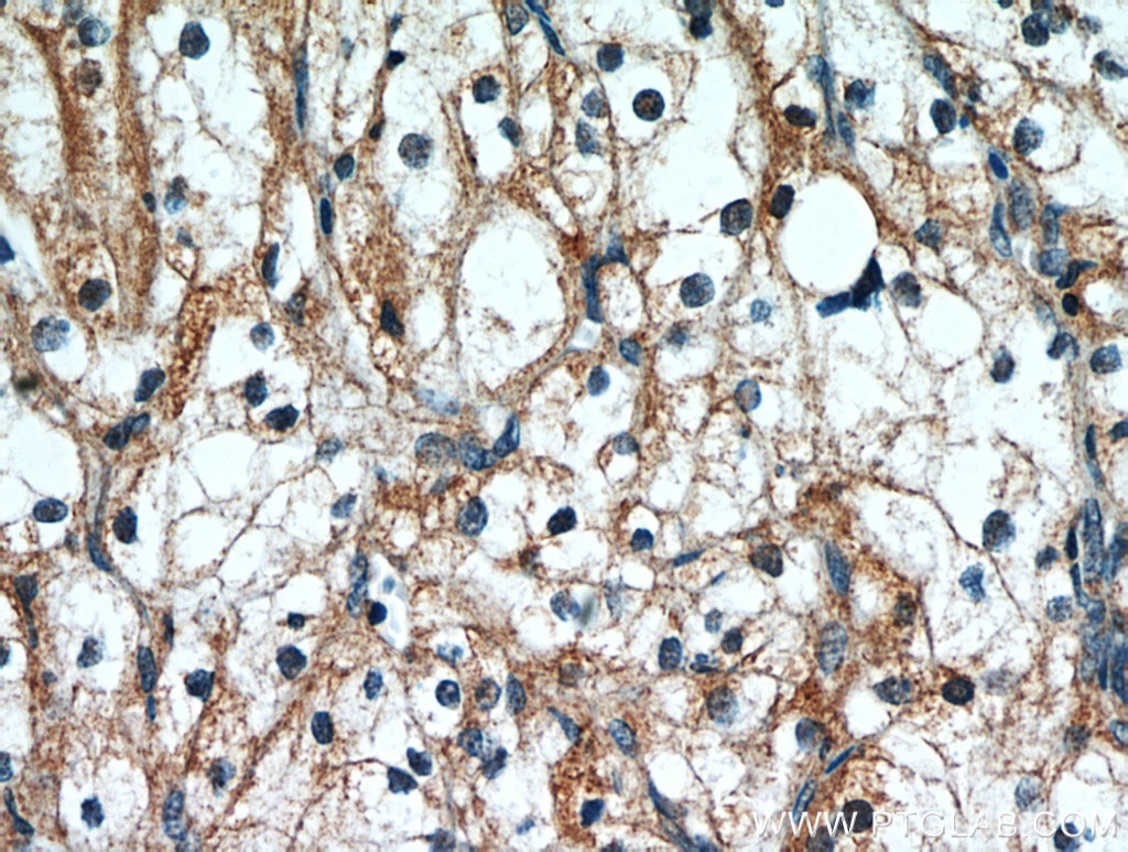 Immunohistochemistry (IHC) staining of human renal cell carcinoma tissue using PTH2R Polyclonal antibody (14166-1-AP)