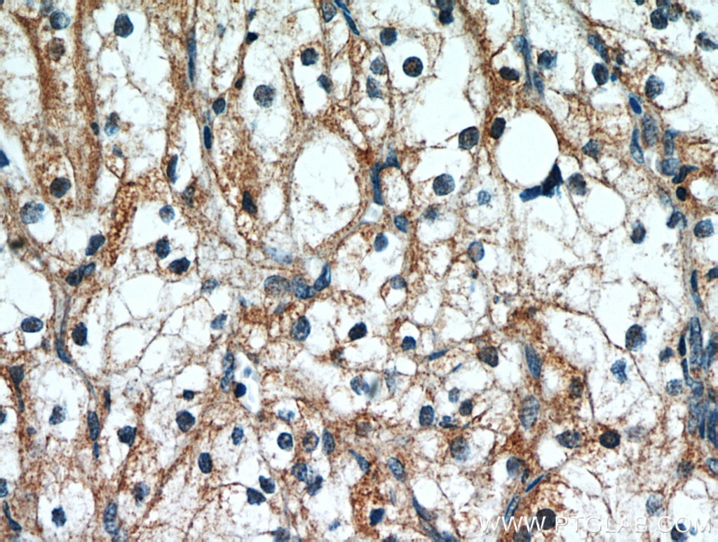 IHC staining of human renal cell carcinoma using 14166-1-AP