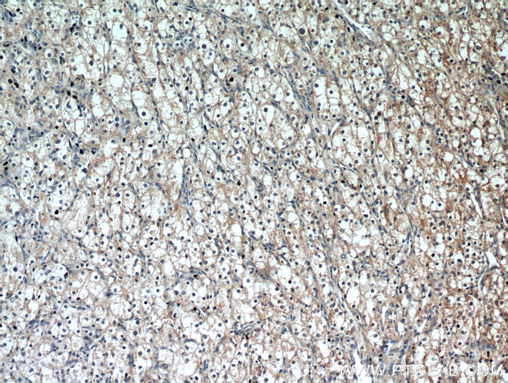 Immunohistochemistry (IHC) staining of human renal cell carcinoma tissue using PTH2R Polyclonal antibody (14166-1-AP)