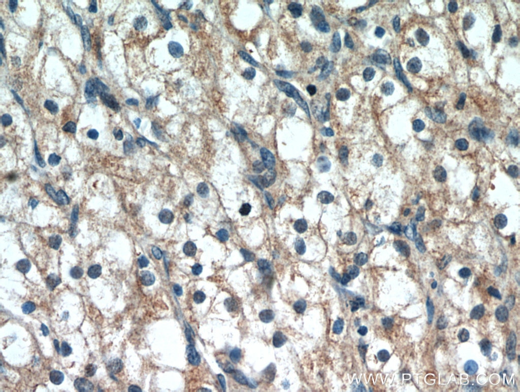 Immunohistochemistry (IHC) staining of human renal cell carcinoma tissue using PTH2R Polyclonal antibody (14166-1-AP)