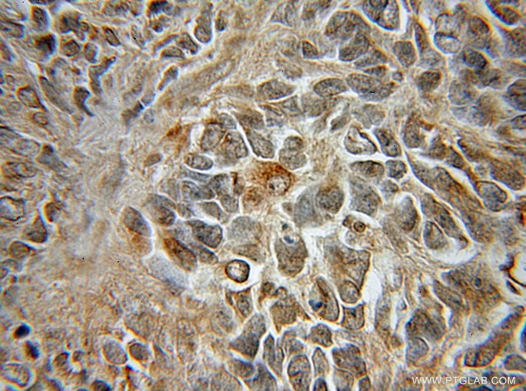 Immunohistochemistry (IHC) staining of human medulloblastoma tissue using PYK2 Polyclonal antibody (10044-2-AP)