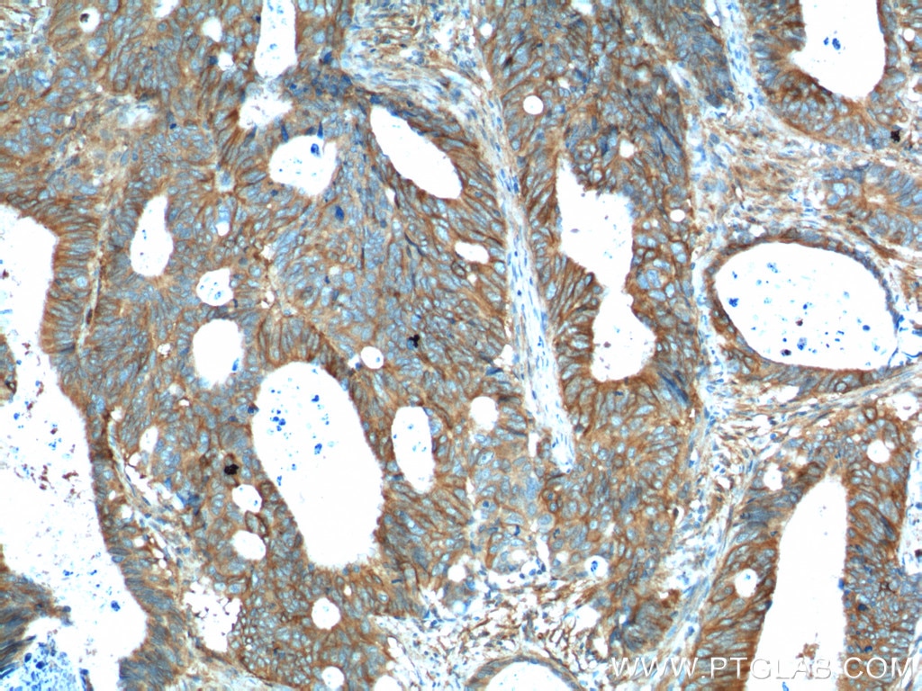 Immunohistochemistry (IHC) staining of human colon cancer tissue using PTK7 Polyclonal antibody (17799-1-AP)