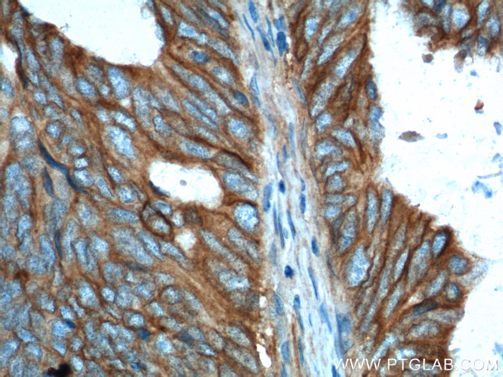 IHC staining of human colon cancer using 17799-1-AP