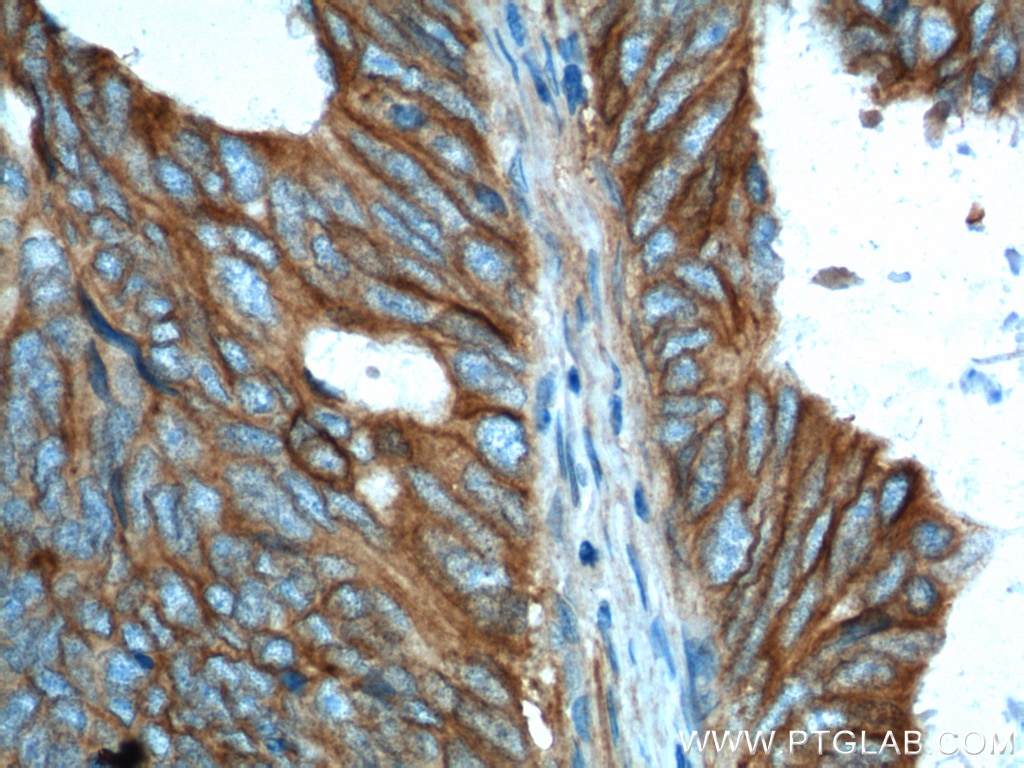 Immunohistochemistry (IHC) staining of human colon cancer tissue using PTK7 Polyclonal antibody (17799-1-AP)