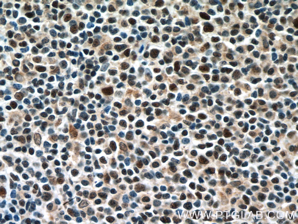 Immunohistochemistry (IHC) staining of human lymphoma tissue using Prothymosin Alpha Polyclonal antibody (10480-1-AP)