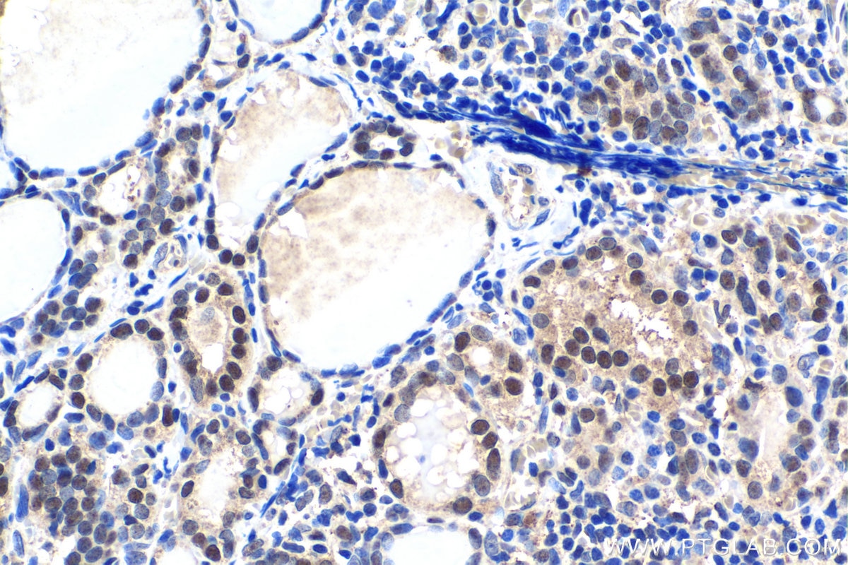 Immunohistochemistry (IHC) staining of human thyroid cancer tissue using Prothymosin Alpha Polyclonal antibody (10480-1-AP)