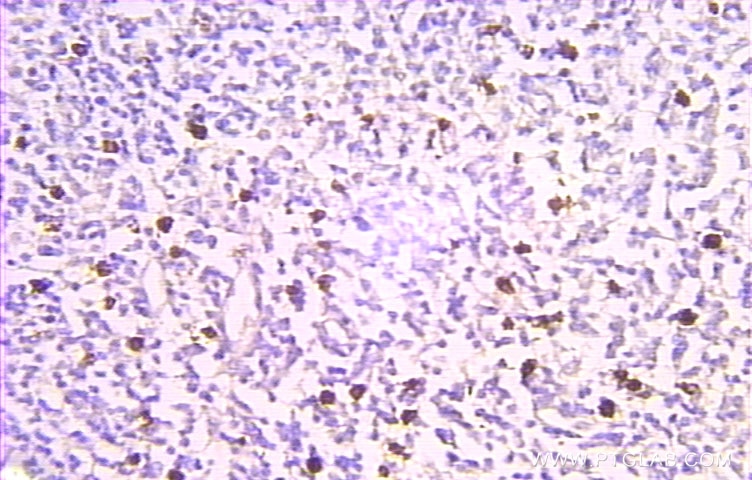 IHC staining of human lymphoma using 10480-1-AP