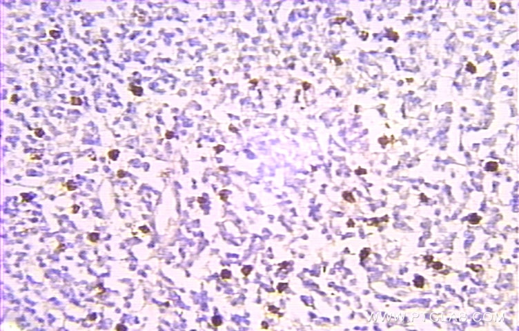 Immunohistochemistry (IHC) staining of human lymphoma tissue using Prothymosin Alpha Polyclonal antibody (10480-1-AP)