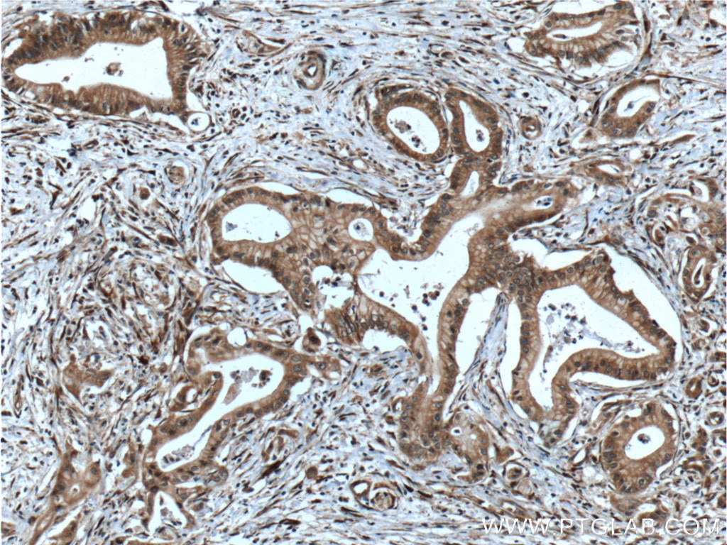 Immunohistochemistry (IHC) staining of human pancreas cancer tissue using PTP4A1/PRL1 Polyclonal antibody (11508-1-AP)