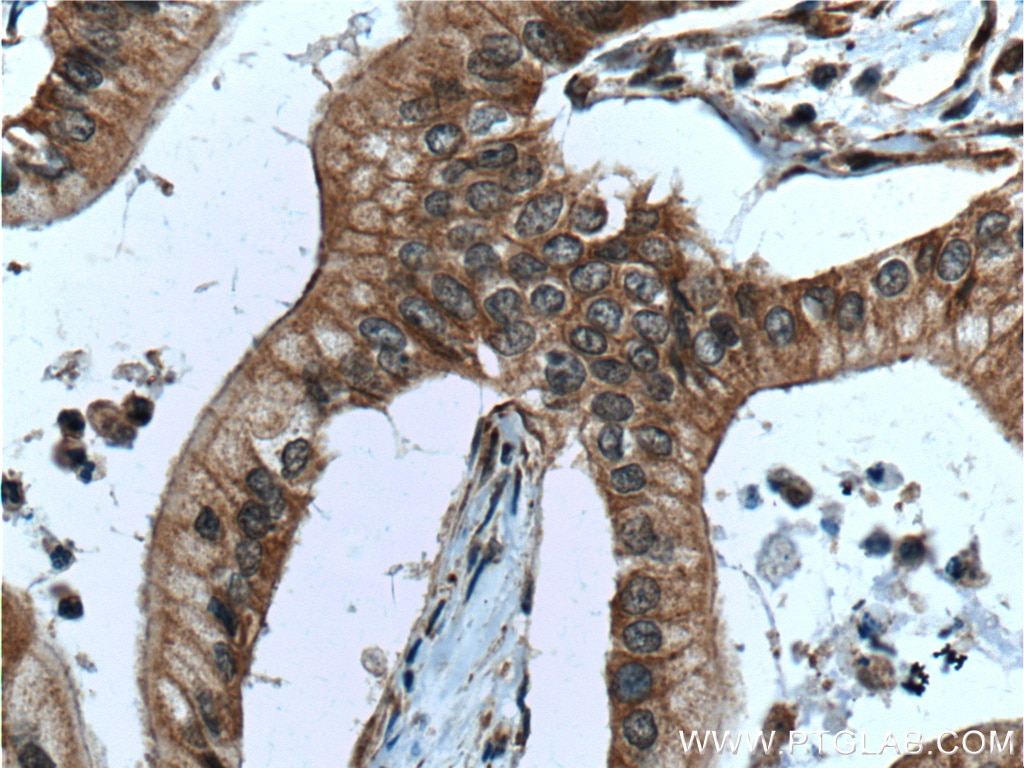 Immunohistochemistry (IHC) staining of human pancreas cancer tissue using PTP4A1/PRL1 Polyclonal antibody (11508-1-AP)