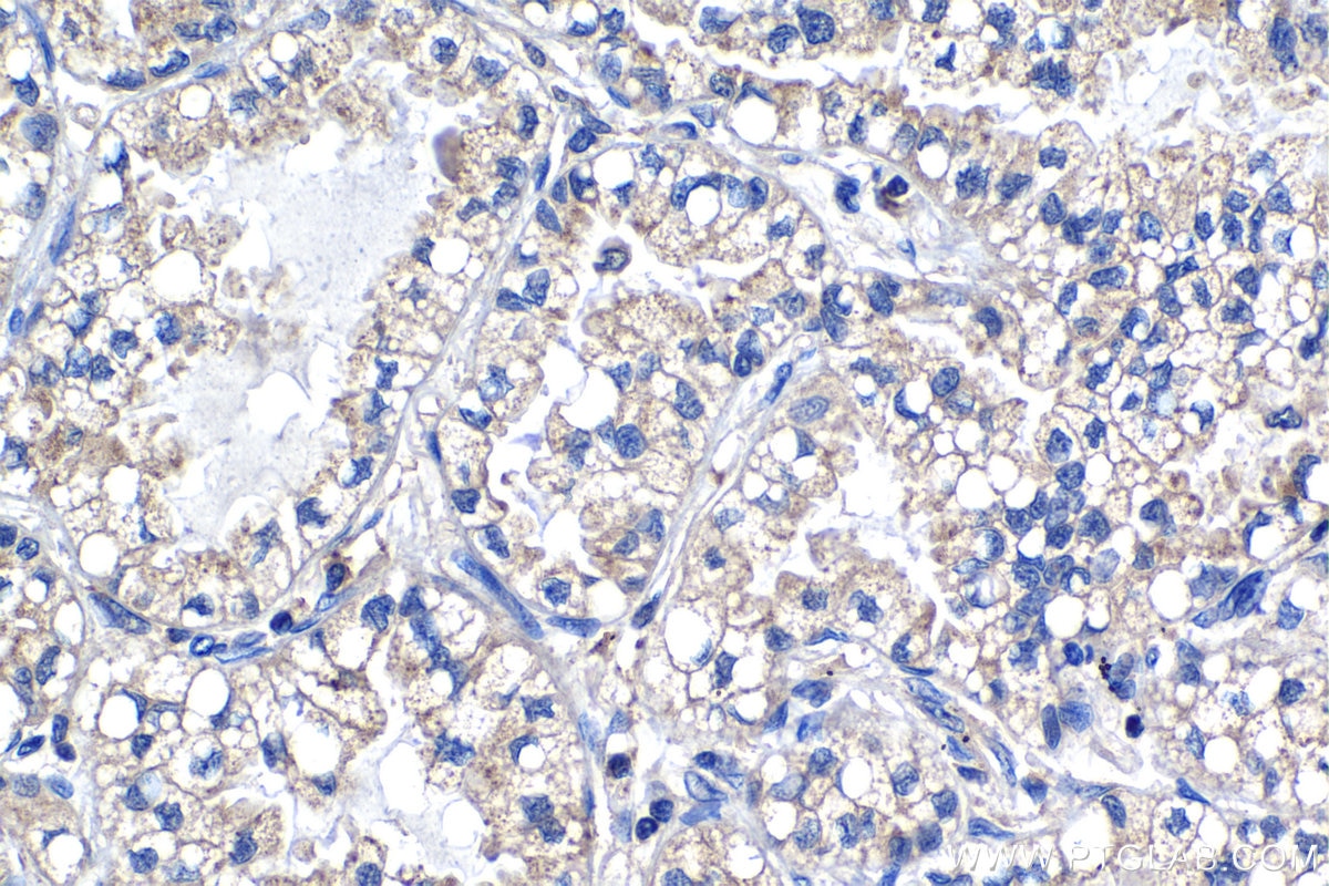 Immunohistochemistry (IHC) staining of human lung cancer tissue using PTP4A1 Monoclonal antibody (67584-1-Ig)