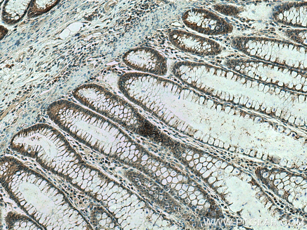 Immunohistochemistry (IHC) staining of human colon cancer tissue using PRL3 Polyclonal antibody (15186-1-AP)