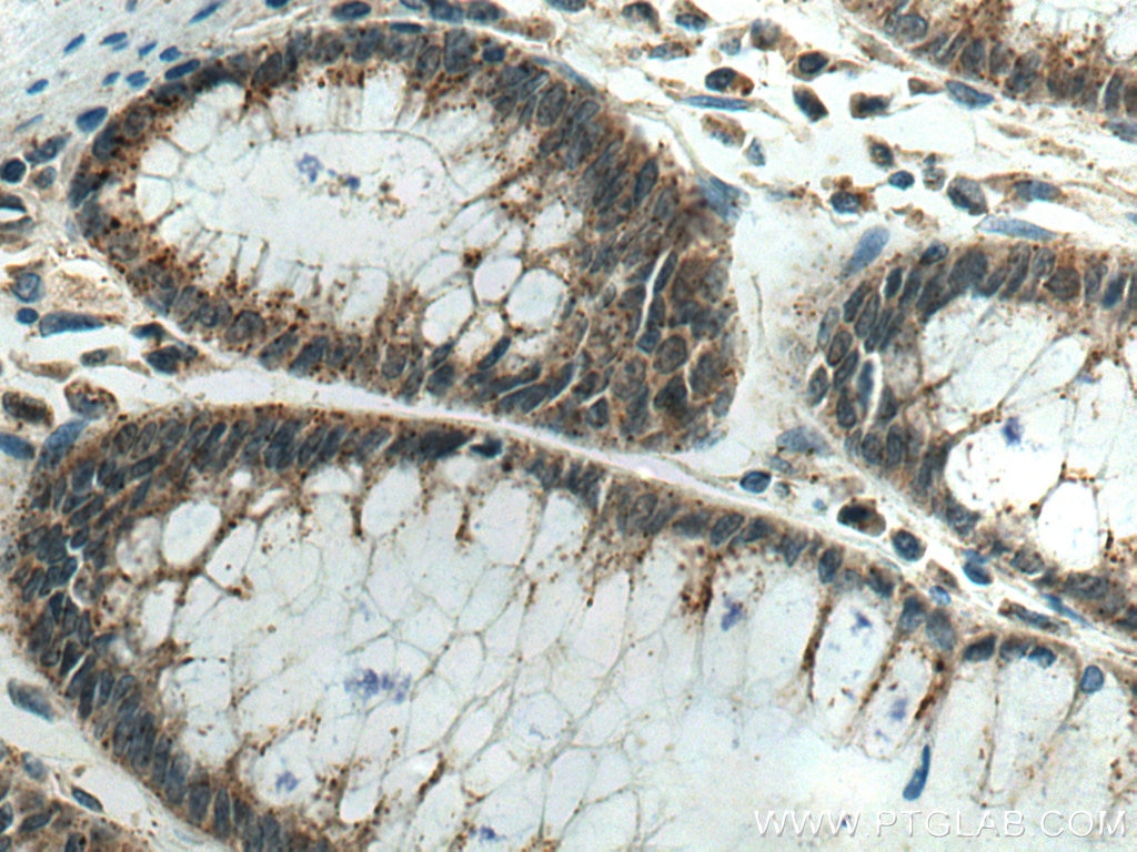 Immunohistochemistry (IHC) staining of human colon cancer tissue using PRL3 Polyclonal antibody (15186-1-AP)