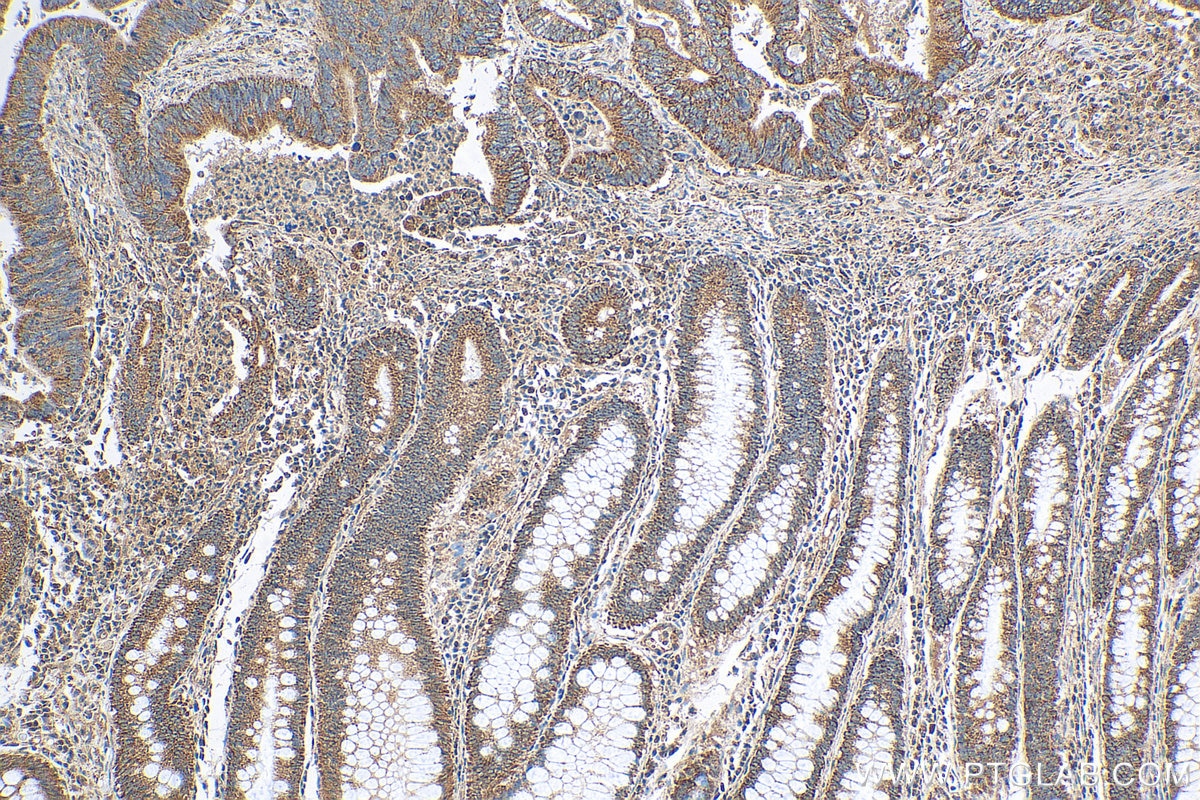 Immunohistochemistry (IHC) staining of human colon cancer tissue using PRL3 Polyclonal antibody (15186-1-AP)