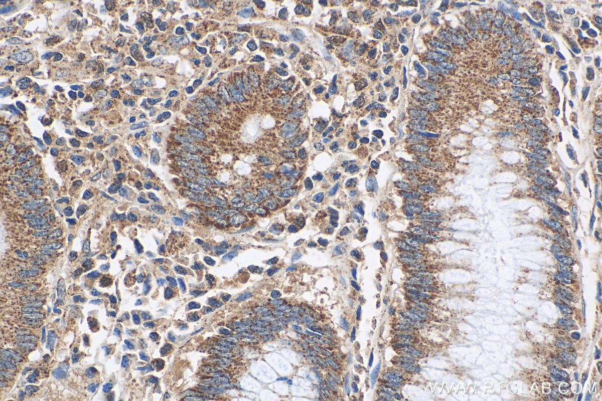 Immunohistochemistry (IHC) staining of human colon cancer tissue using PRL3 Polyclonal antibody (15186-1-AP)