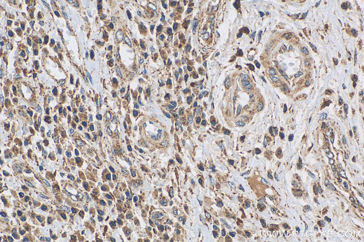 Immunohistochemistry (IHC) staining of human oesophagus cancer tissue using PRL3 Polyclonal antibody (15186-1-AP)