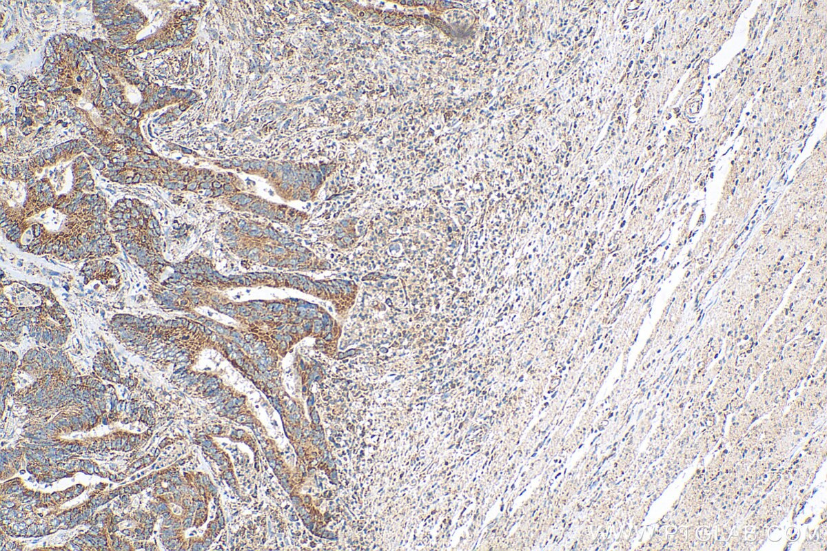 Immunohistochemistry (IHC) staining of human colon cancer tissue using PRL3 Polyclonal antibody (15186-1-AP)