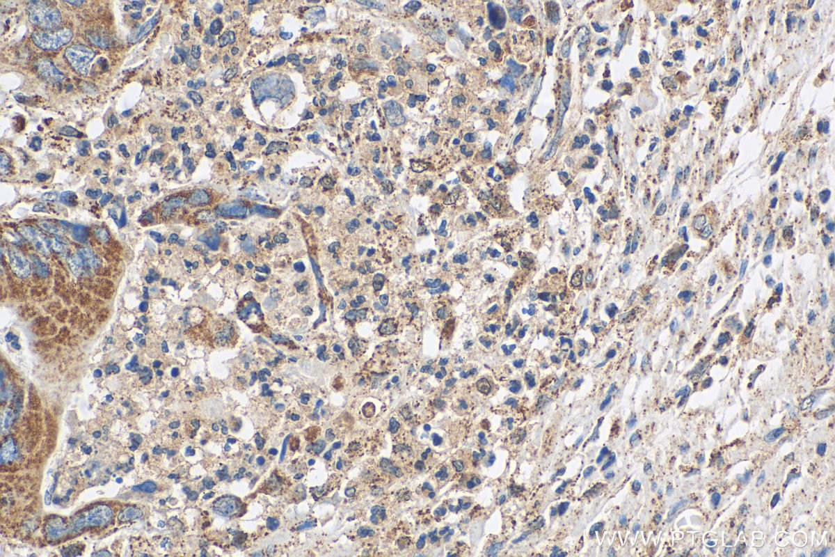 Immunohistochemistry (IHC) staining of human colon cancer tissue using PRL3 Polyclonal antibody (15186-1-AP)
