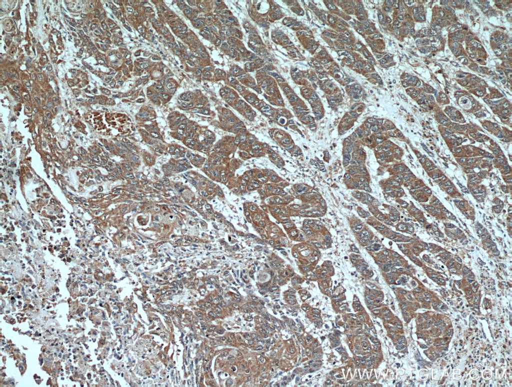 Immunohistochemistry (IHC) staining of human oesophagus cancer tissue using PRL3 Polyclonal antibody (15186-1-AP)