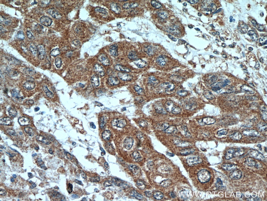 Immunohistochemistry (IHC) staining of human oesophagus cancer tissue using PRL3 Polyclonal antibody (15186-1-AP)