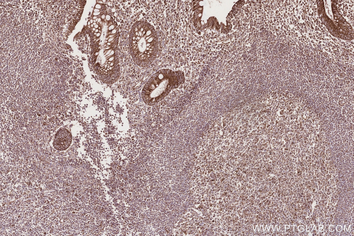 Immunohistochemistry (IHC) staining of human appendicitis tissue using PTPIP51 Polyclonal antibody (20641-1-AP)