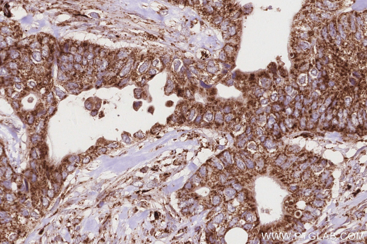 Immunohistochemistry (IHC) staining of human rectal cancer tissue using PTPIP51 Polyclonal antibody (20641-1-AP)