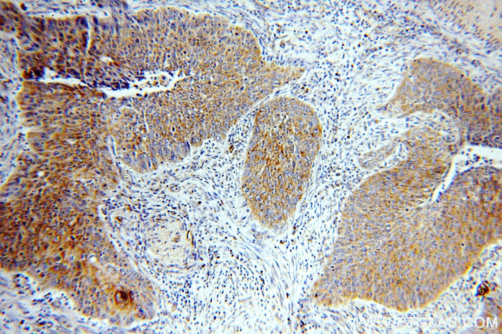 Immunohistochemistry (IHC) staining of human cervical cancer tissue using PTPIP51 Polyclonal antibody (20641-1-AP)