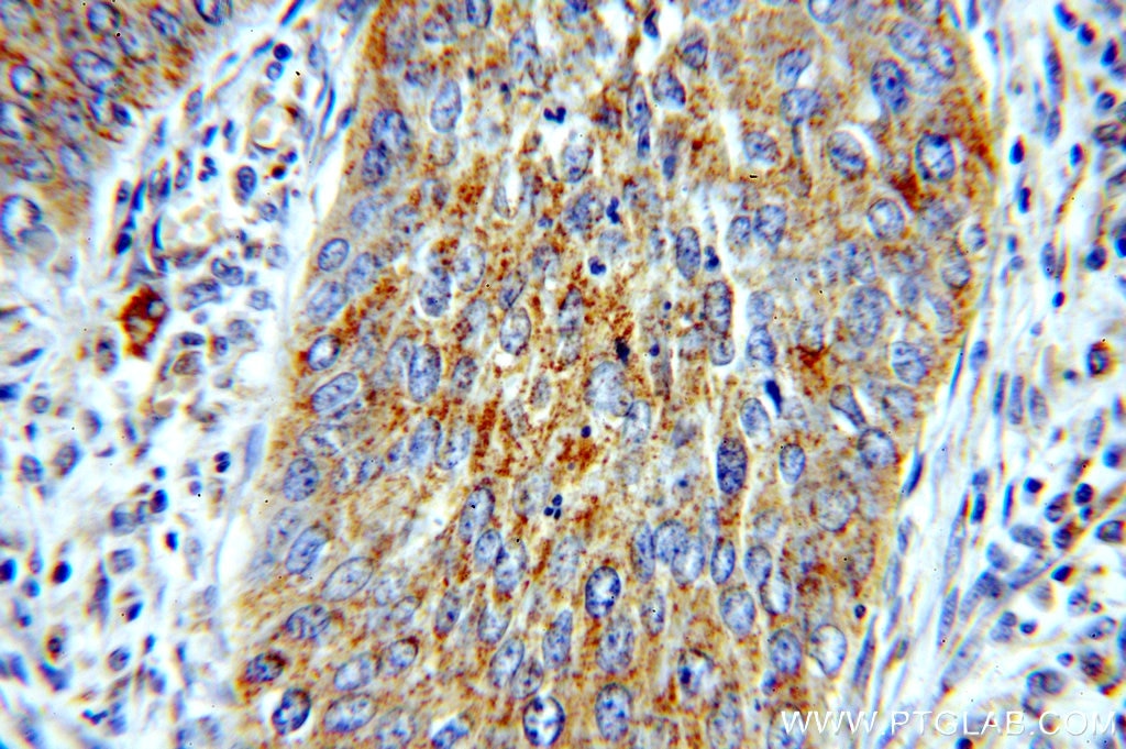 Immunohistochemistry (IHC) staining of human cervical cancer tissue using PTPIP51 Polyclonal antibody (20641-1-AP)