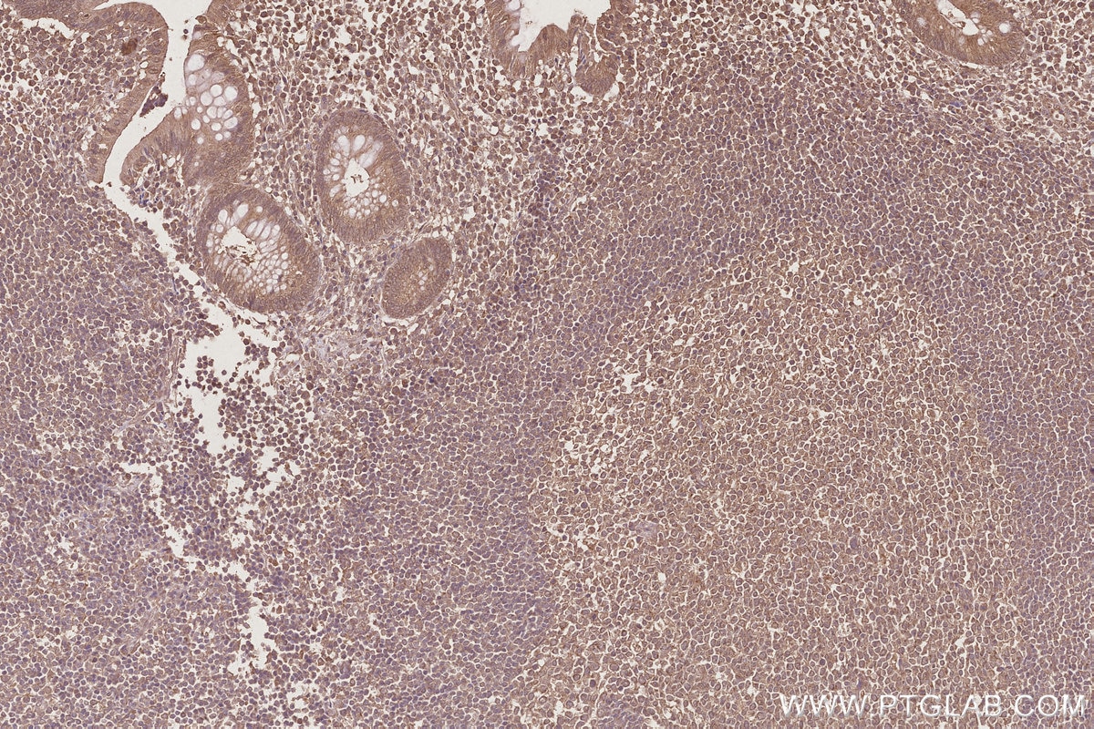 IHC staining of human appendicitis using 68582-1-Ig Immunohistochemistry (IHC) staining of human appendicitis tissue using PTPIP51 Monoclonal antibody (68582-1-Ig)