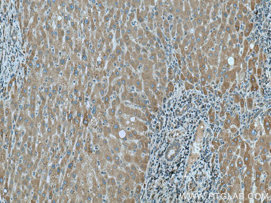 IHC staining of human liver cancer using 28572-1-AP